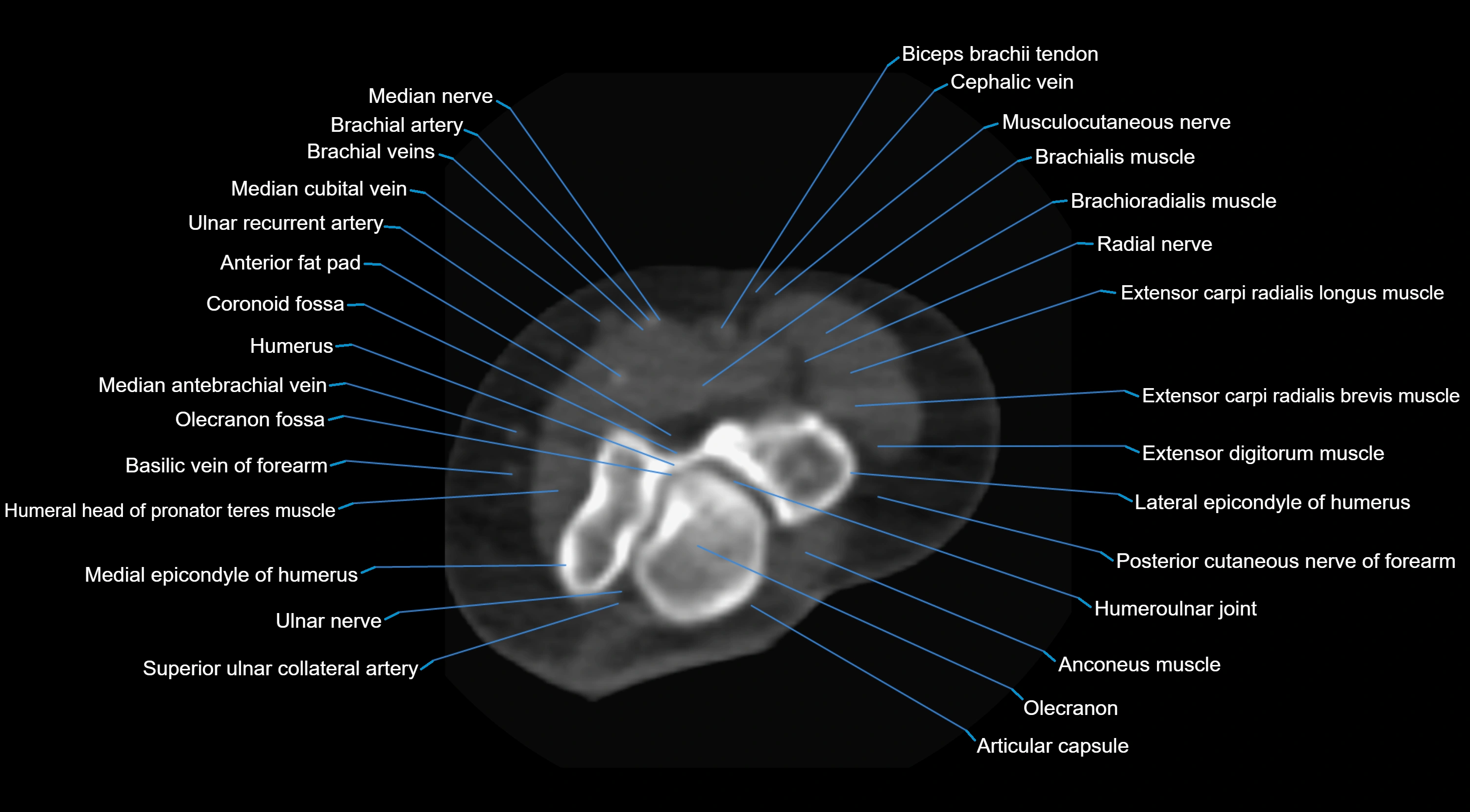 CT elbow axial  cross sectional anatomy labelled  radiology image -00019.webp